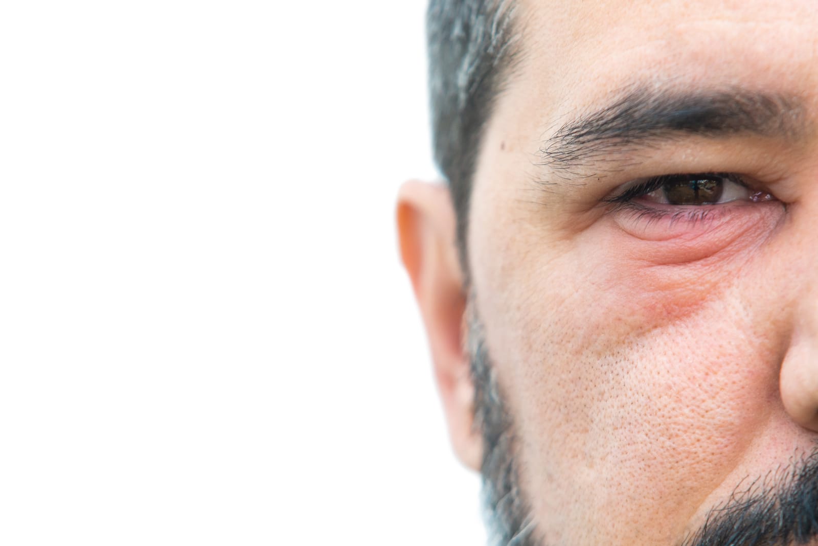 Meibomian Gland Dysfunction | St. George Eye Center
