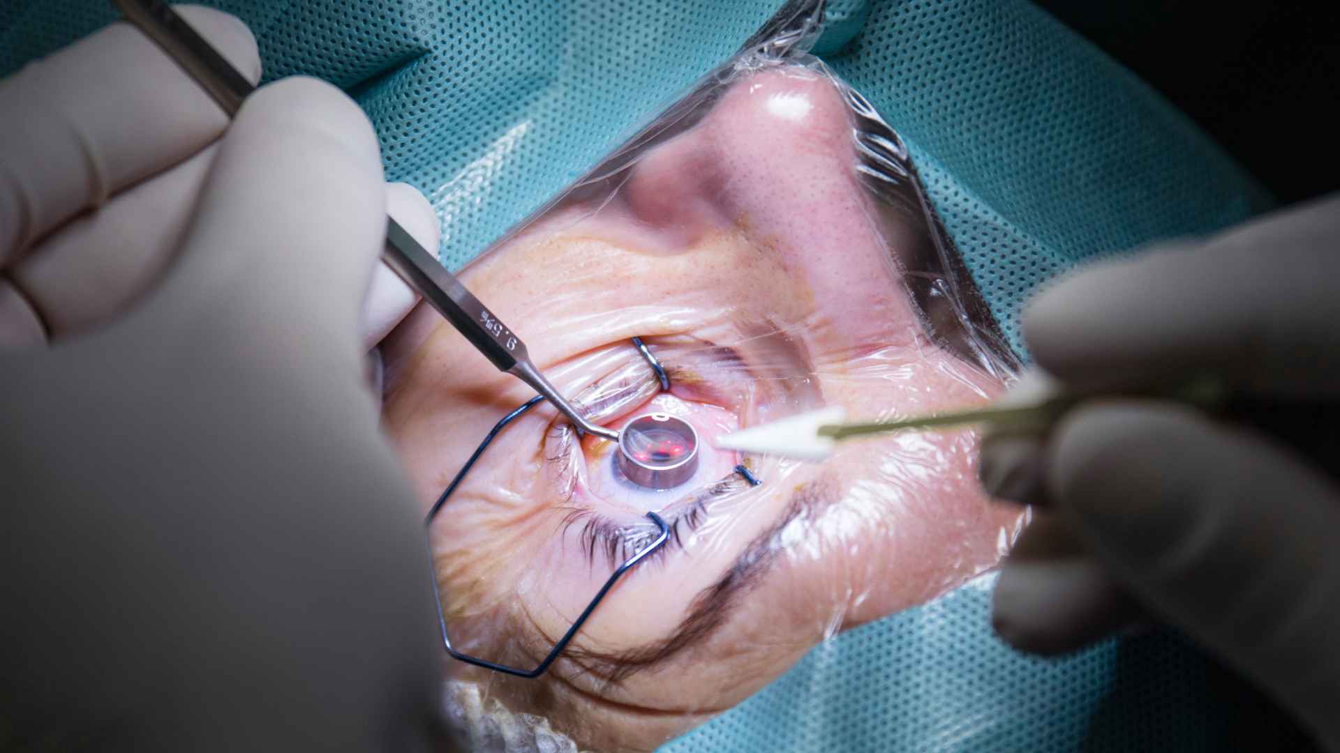 Dropless Cataract Surgery | St. George Eye Center