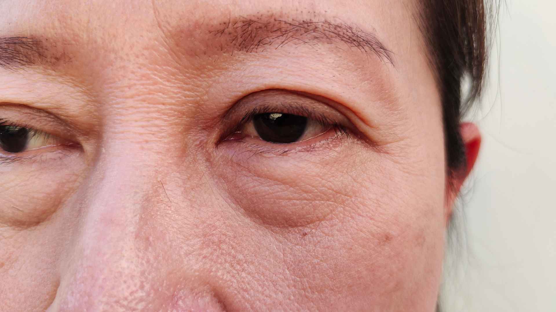 Ptosis: Causes and Treatment for Drooping Eyelids | St. George Eye Center