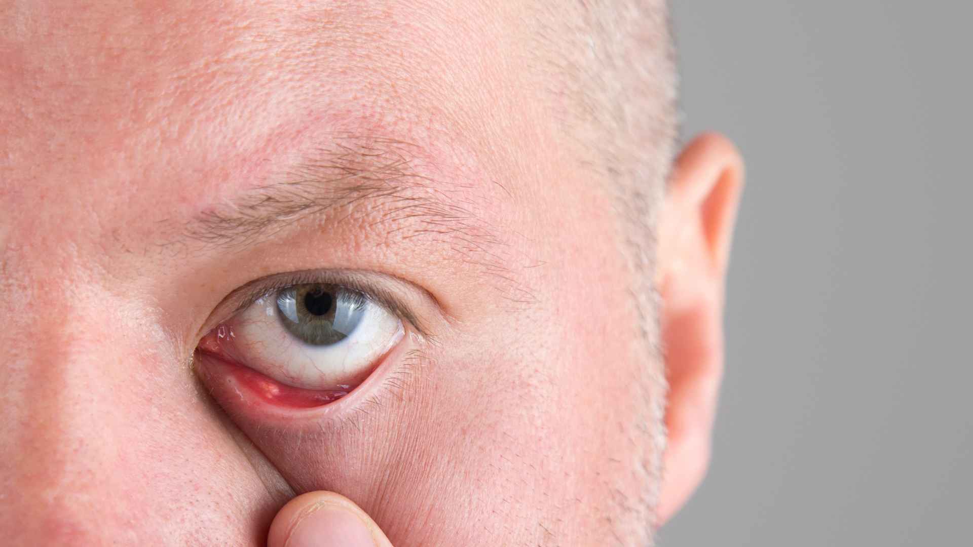 Internal vs. External Stye: Key Differences Explained | St. George Eye Center