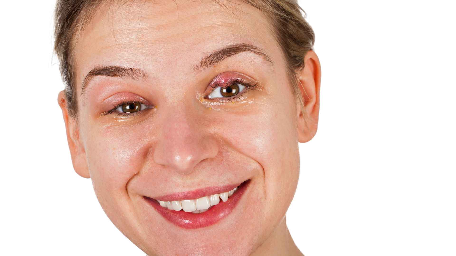 Stye vs. Pimple on Eyelid: How to Tell the Difference | St. George Eye Center
