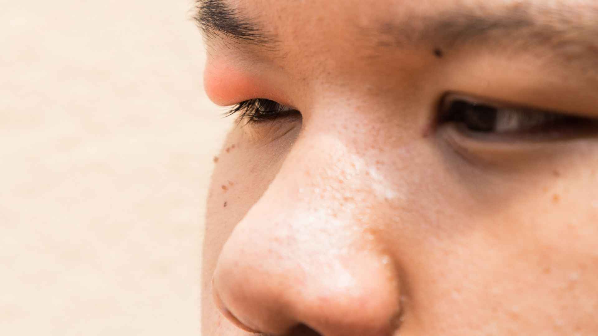 Best Eye Drops for a Stye | St. George Eye Center