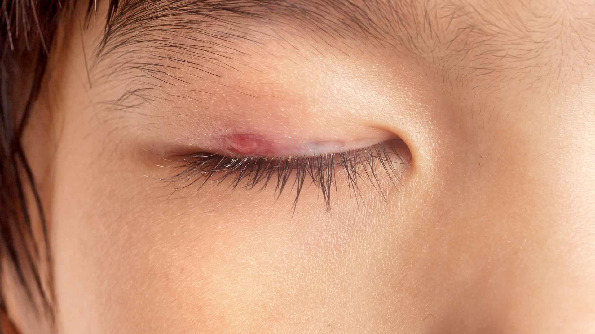 What Happens If You Pop a Stye? | St. George Eye Center