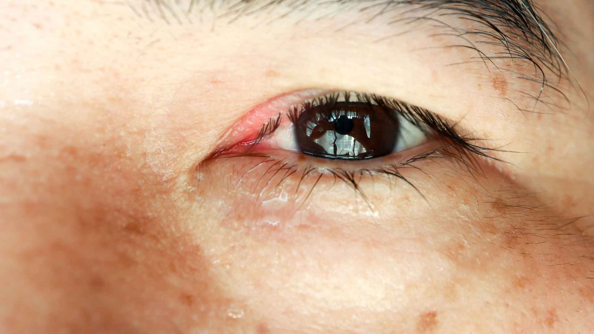Can Blepharitis Cause Styes? | St. George Eye Center
