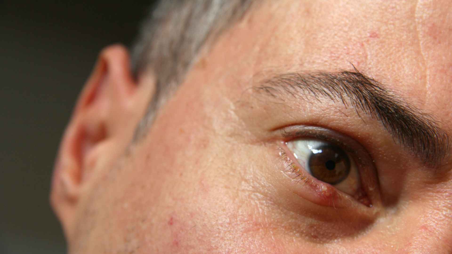 Stye Under the Eyelid | St. George Eye Center