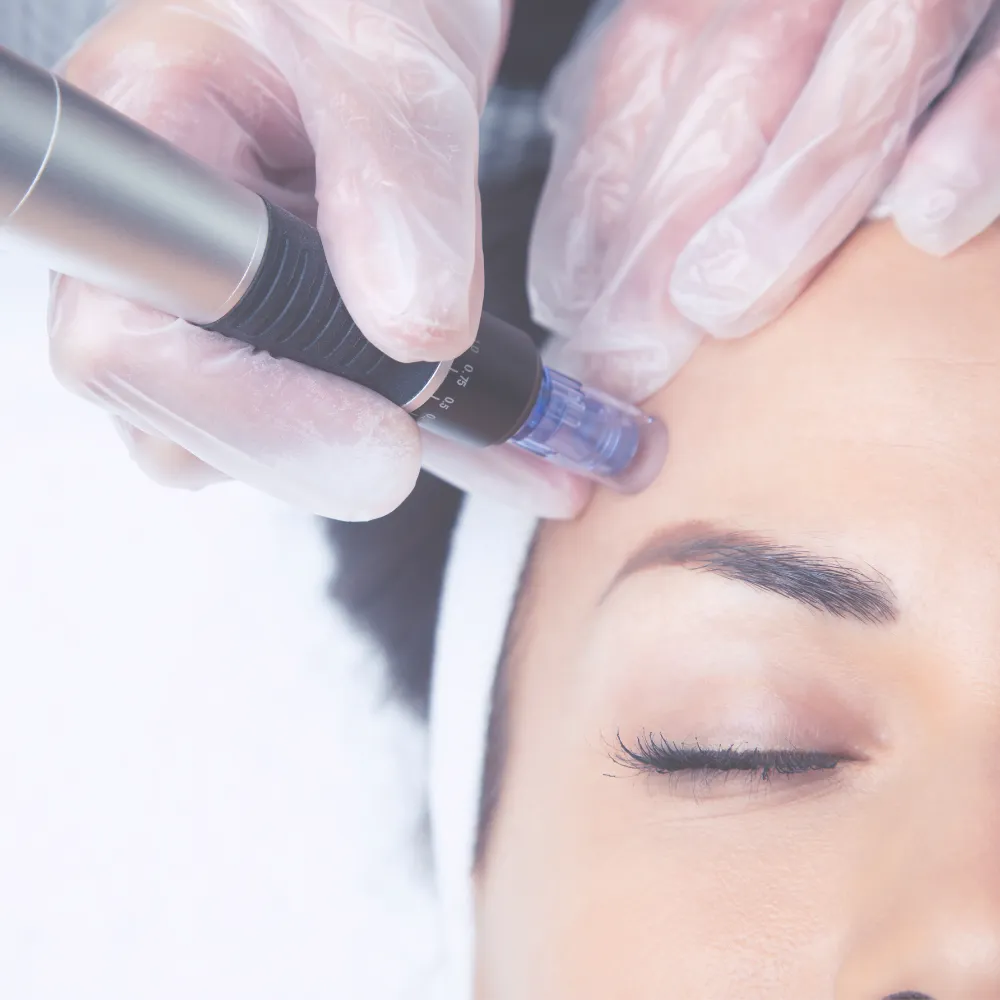 PRP treatment