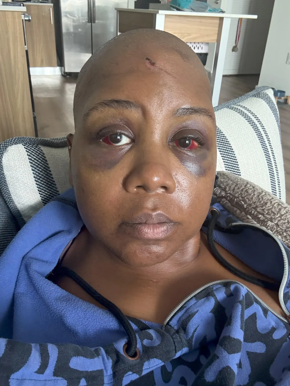 Image of woman with a bruised face and bloody eyes