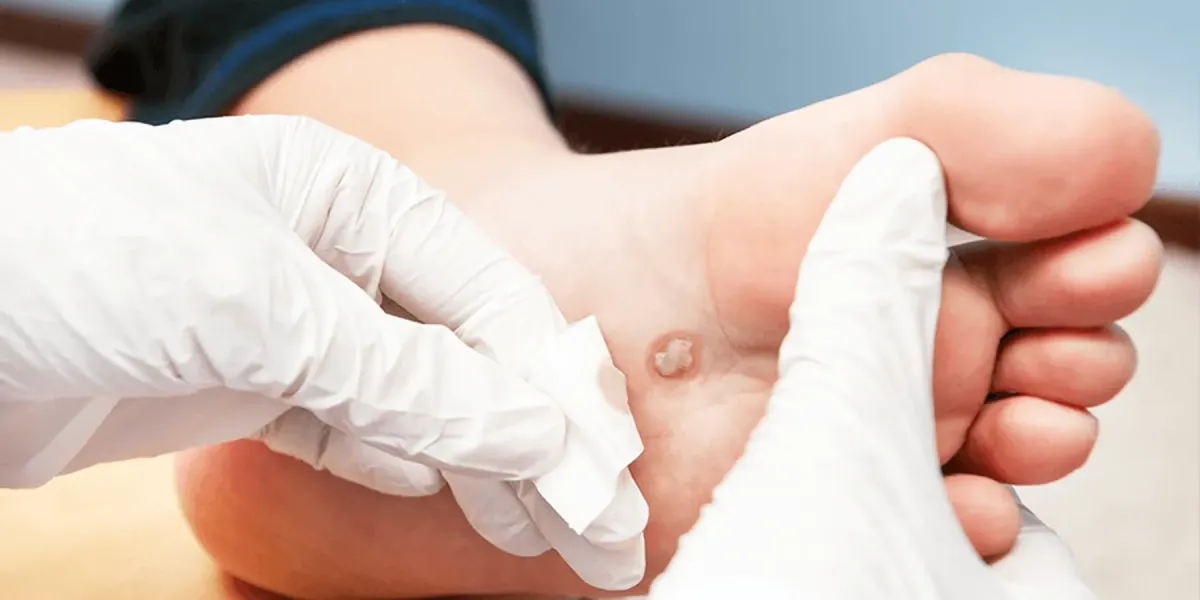 When Should You Consider Verruca Needling?