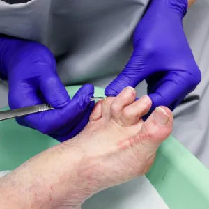 Fed Up With Painful Corns? Could Curacorn® Be the Solution?