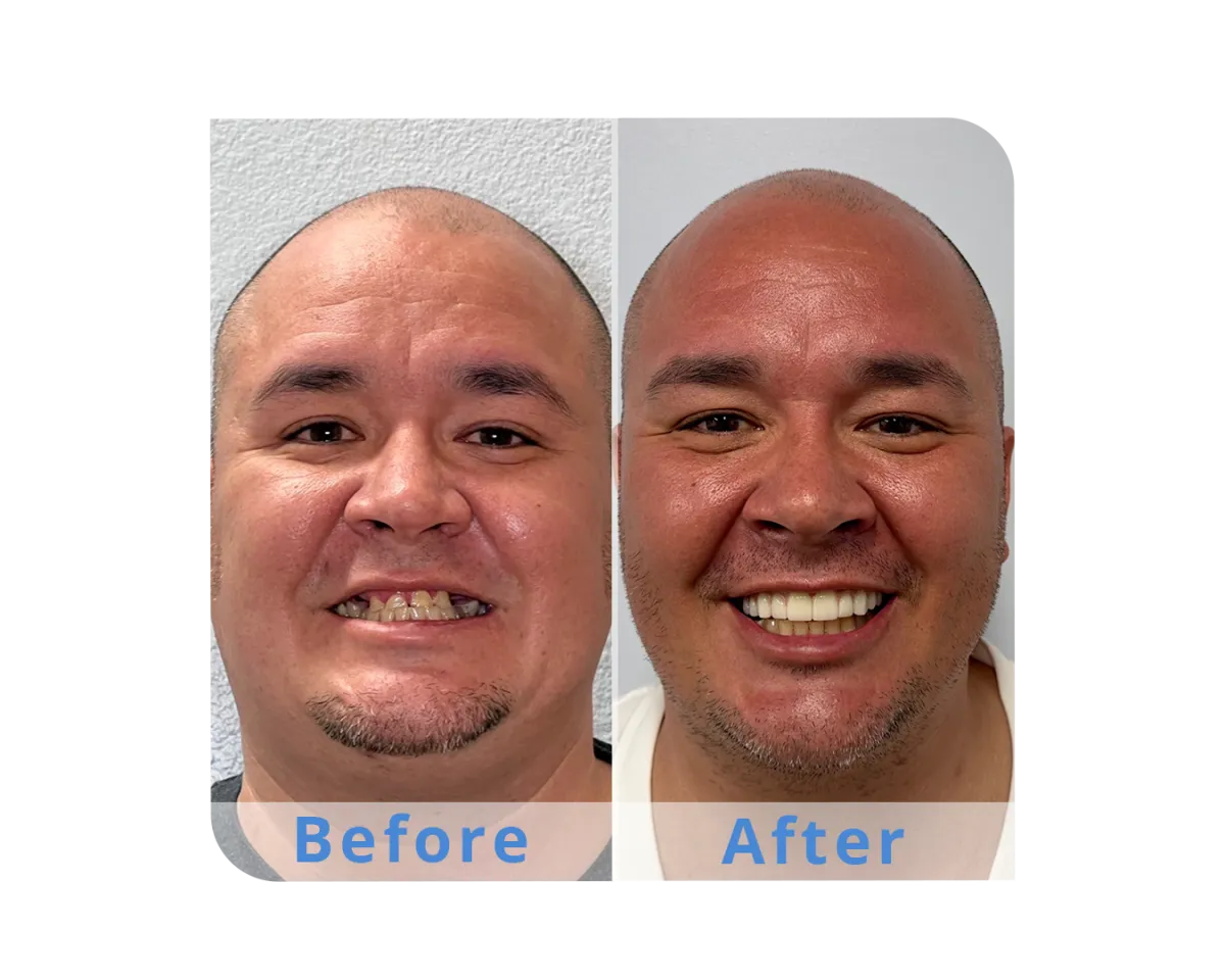 North End Dental Dental Implant Options