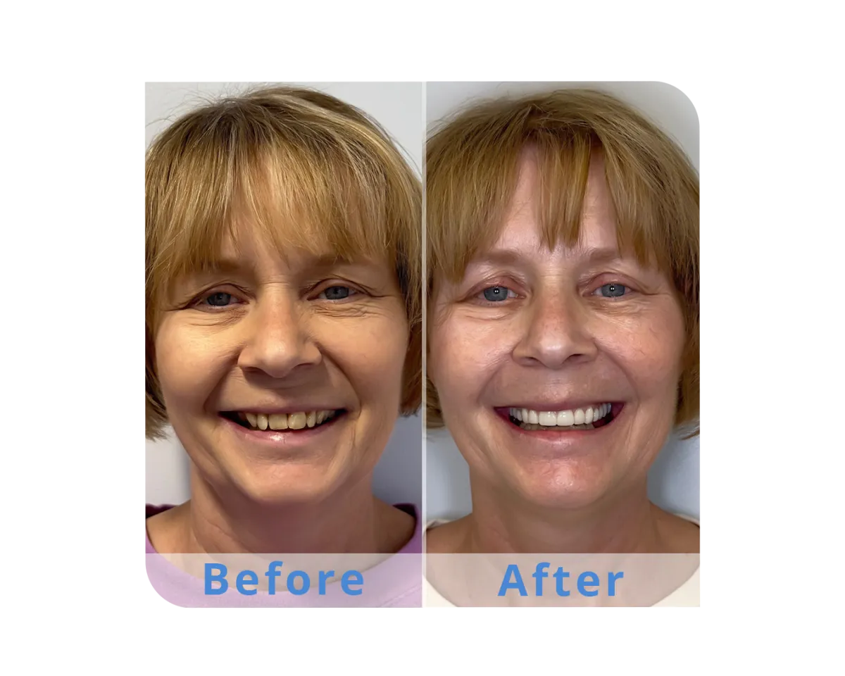 North End Dental Dental Implant Options