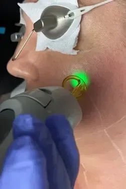 Skin Tightening Laser Treatment