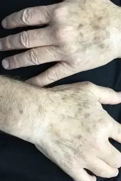 Sunspot removal In Houston