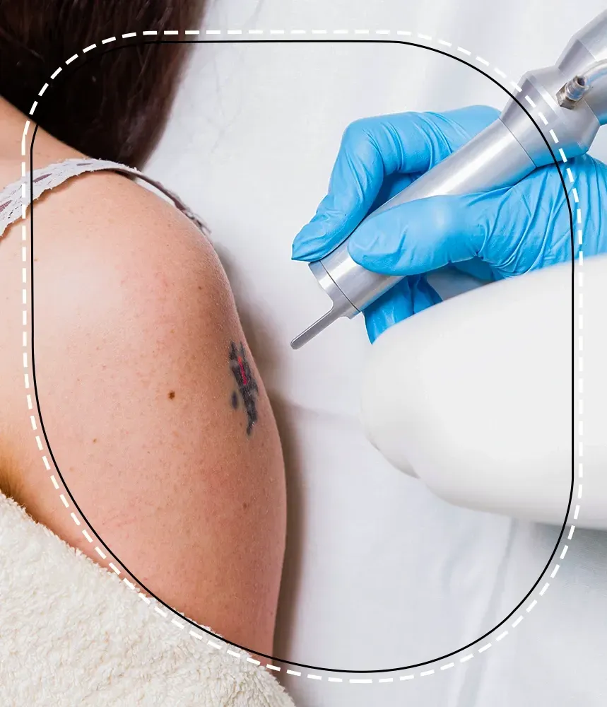 Tattoo removal