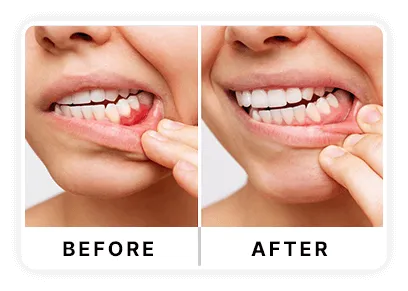 girl before and after using dentavive