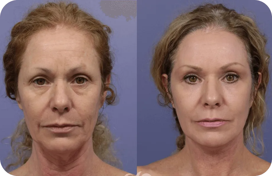 Before and after Dara