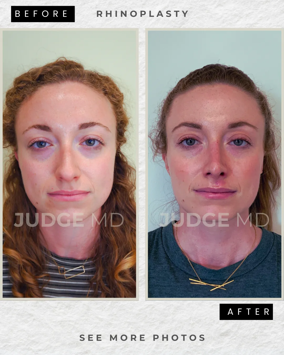Rhinoplasty Case Study 1 - before and after