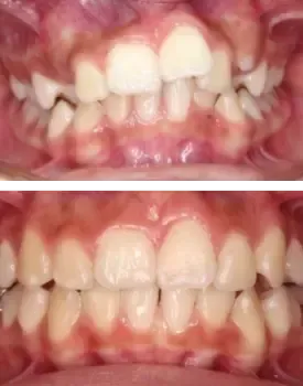 Teeth Alignment