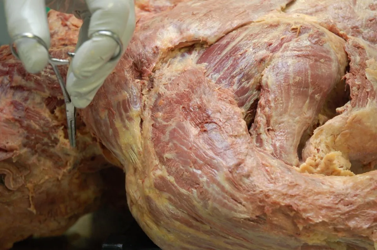 shoulder dissection of deltoid and teres major and minor