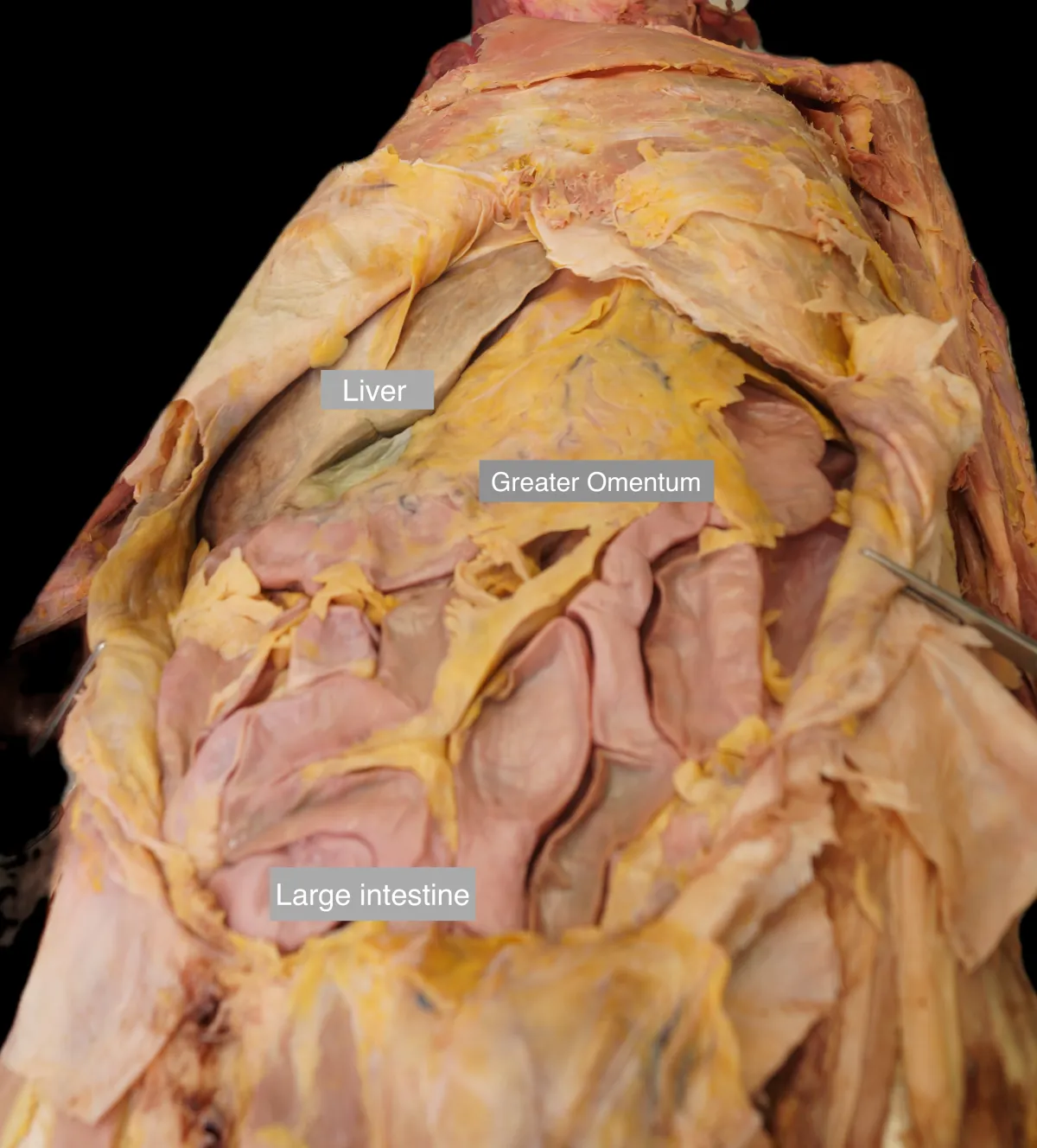 Dissection of greater omentum liver and large intesting