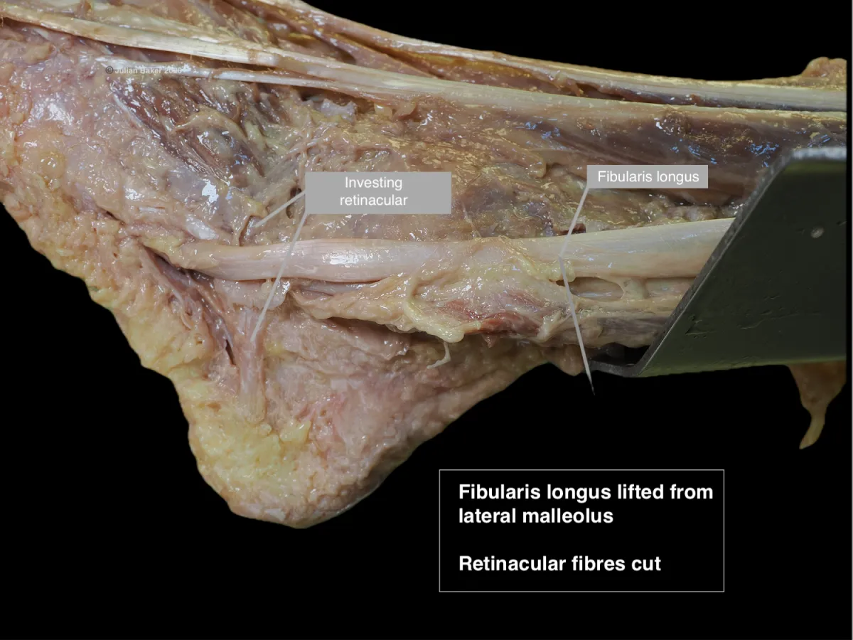dissection of fibularis longus reflected from lateral malleolus with investing retinacular removed
