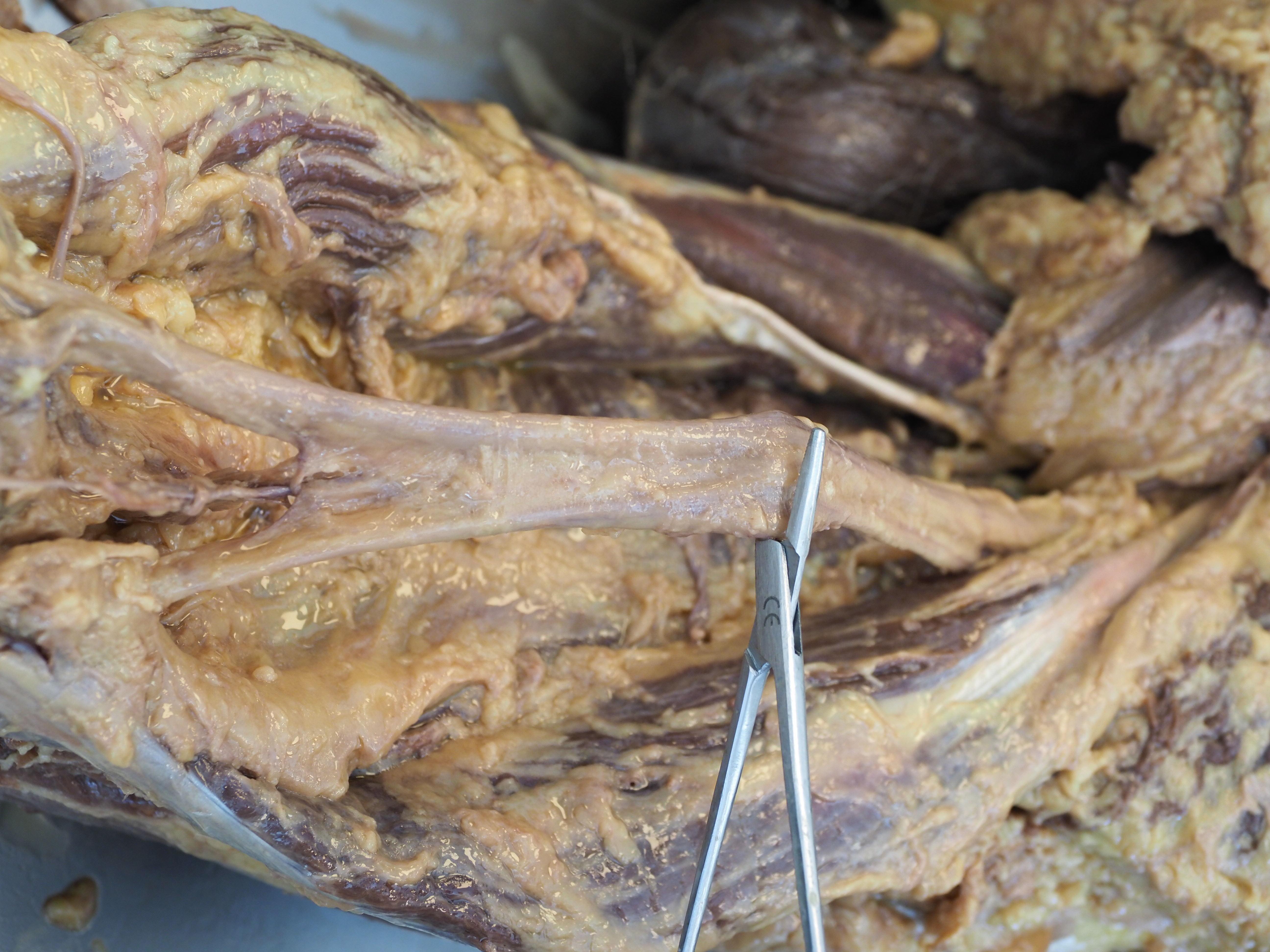 Sciatic nerve dissected at posterior thigh