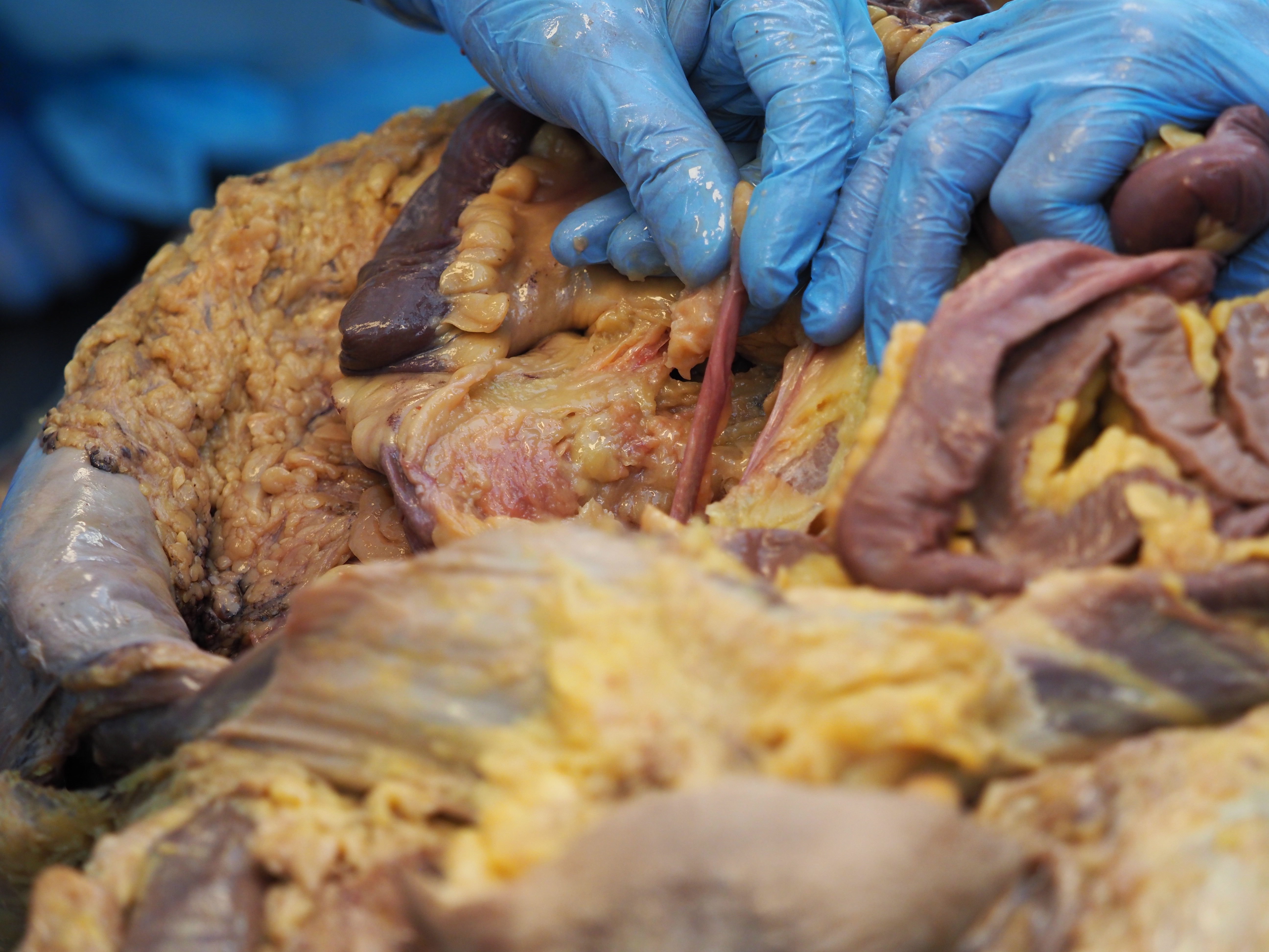 dissection of vermiform appendix attached to iliocecal junction