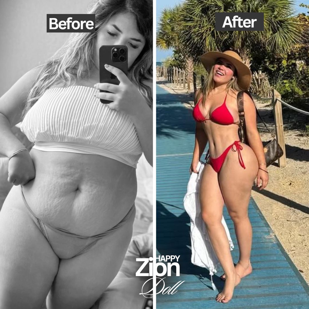 Tummy tuck Before and after