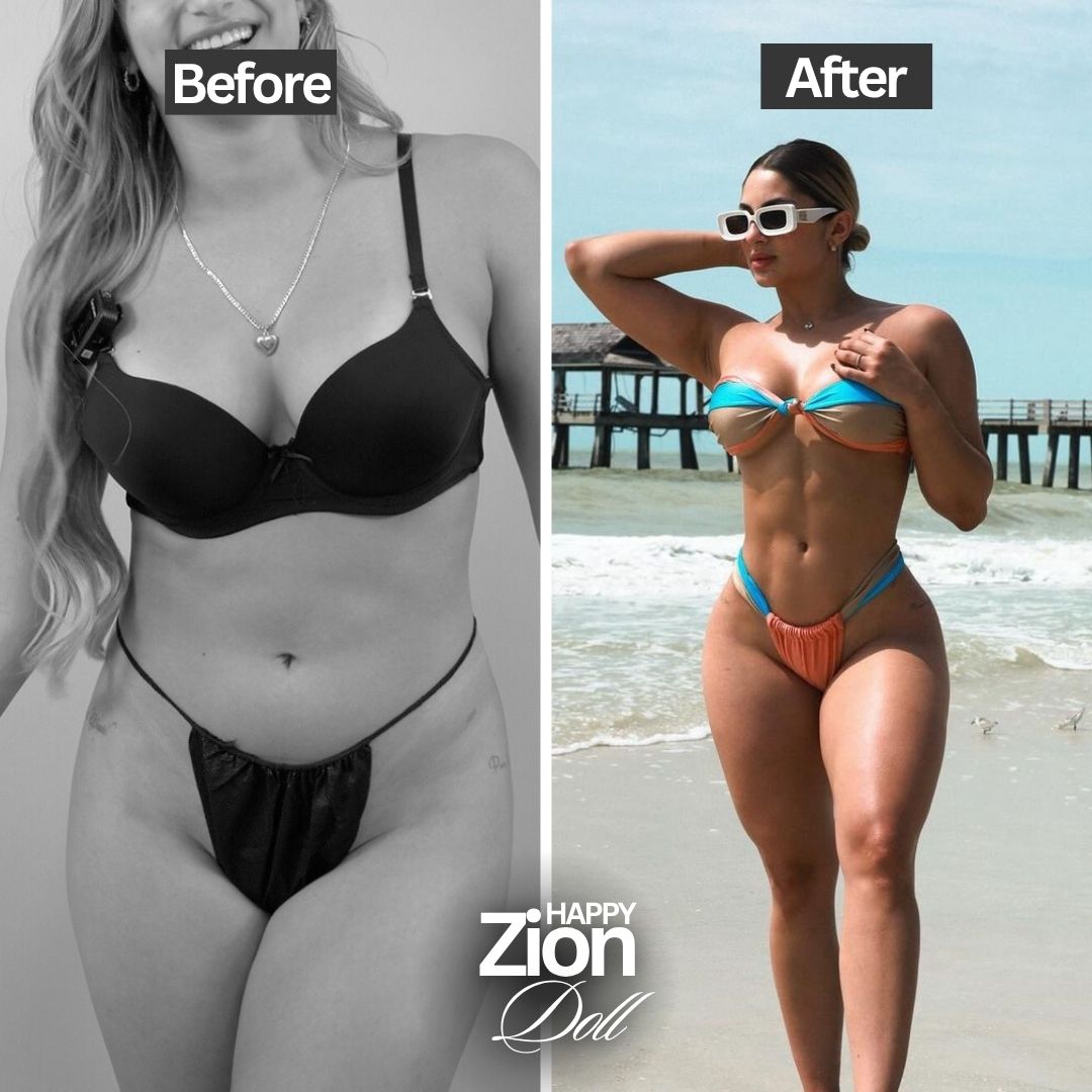 Lipo HD before and after