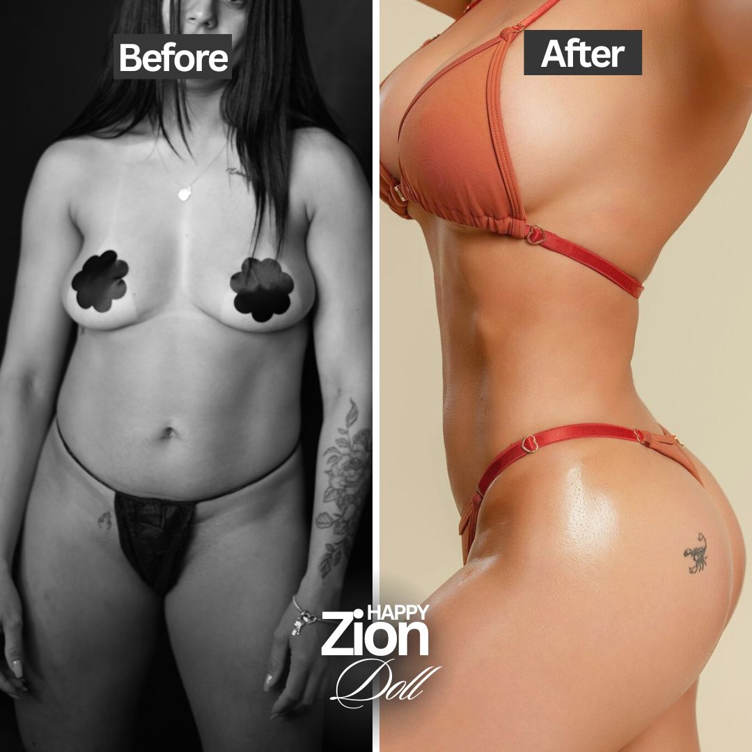 Mommy makeover Before and after