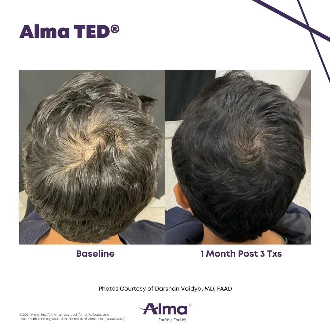 Before-and-after photos of a man’s scalp showing hair restoration progress. The left image labeled ‘Baseline’ shows thinning hair with visible scalp at the crown, while the right image labeled ‘1 Month Post 3 Txs’ shows noticeably thicker hair and improved scalp coverage after three Alma TED® treatments.
