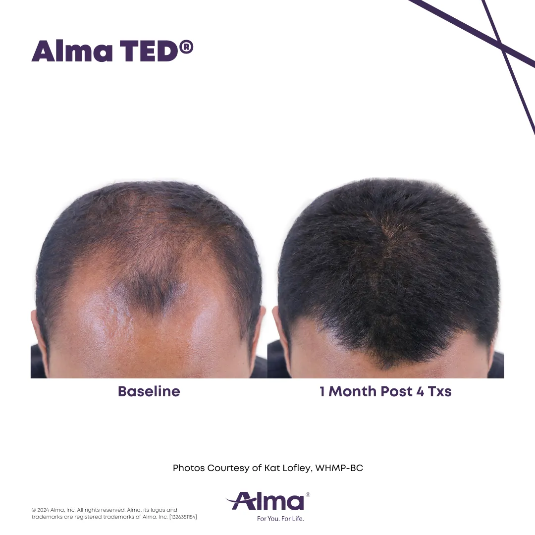 Before-and-after comparison of a man’s scalp showing results from Alma TED® hair restoration treatment. The left image labeled ‘Baseline’ shows significant thinning at the crown, while the right image labeled ‘1 Month Post 4 Txs’ shows visibly fuller hair after four treatment sessions.