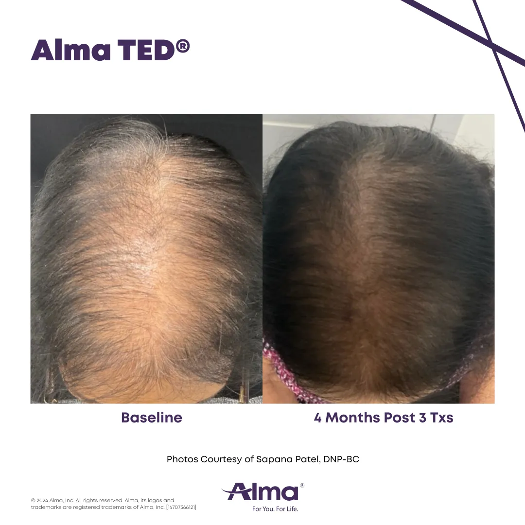 Side-by-side comparison of a woman’s scalp showing results from Alma TED® treatment. The left image labeled ‘Baseline’ displays visible thinning and scalp exposure, while the right image labeled ‘4 Months Post 3 Txs’ shows significantly fuller hair with improved scalp coverage.
