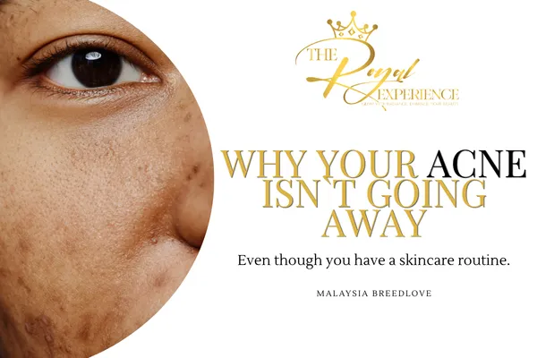 Why Your Acne Persists Despite Skincare Routine