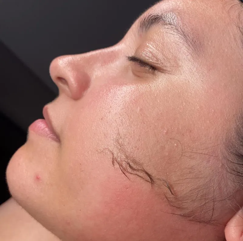 Facial Treatments