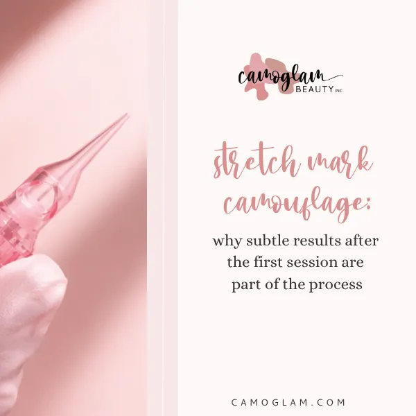 stretch mark camouflage: why subtle results after the first session are part of the process