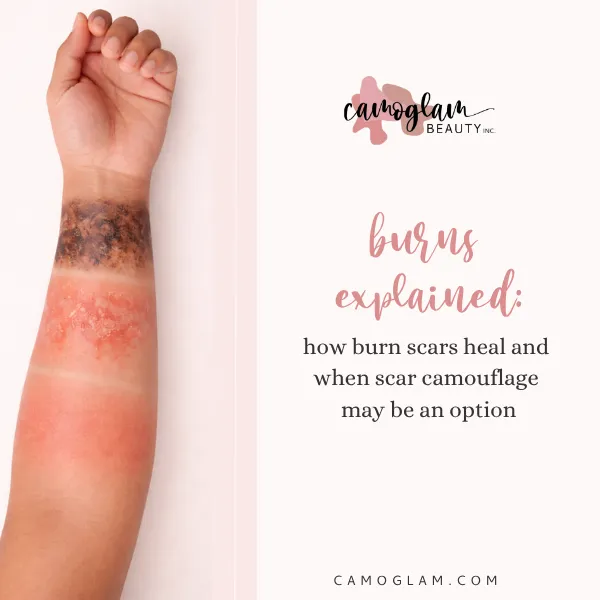 burns explained: how burn scars heal and when scar camouflage may be an option