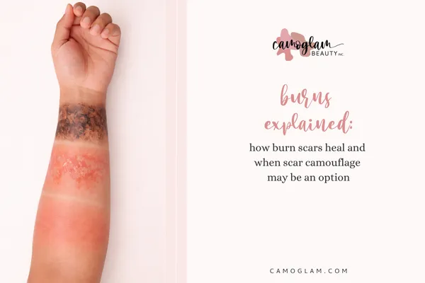 burns explained: how burn scars heal and when scar camouflage may be an option