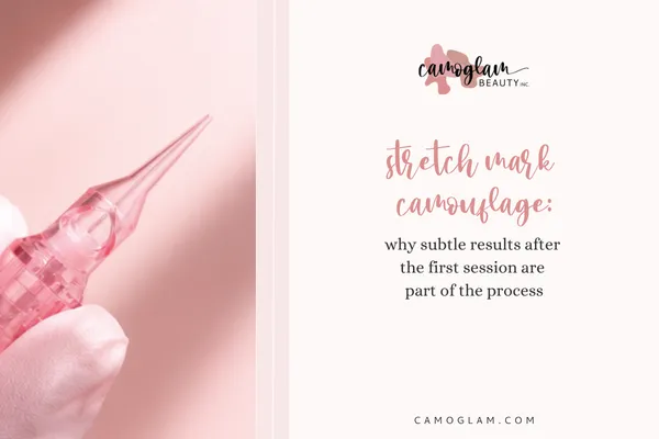 stretch mark camouflage: why subtle results after the first session are part of the process