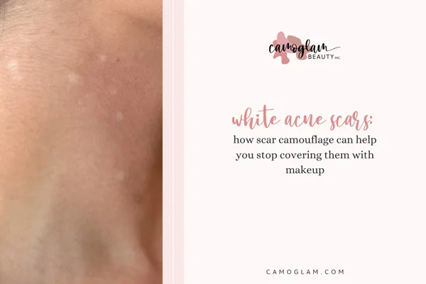 White Acne Scars: How Scar Camouflage Can Help You Stop Covering Them With Makeup