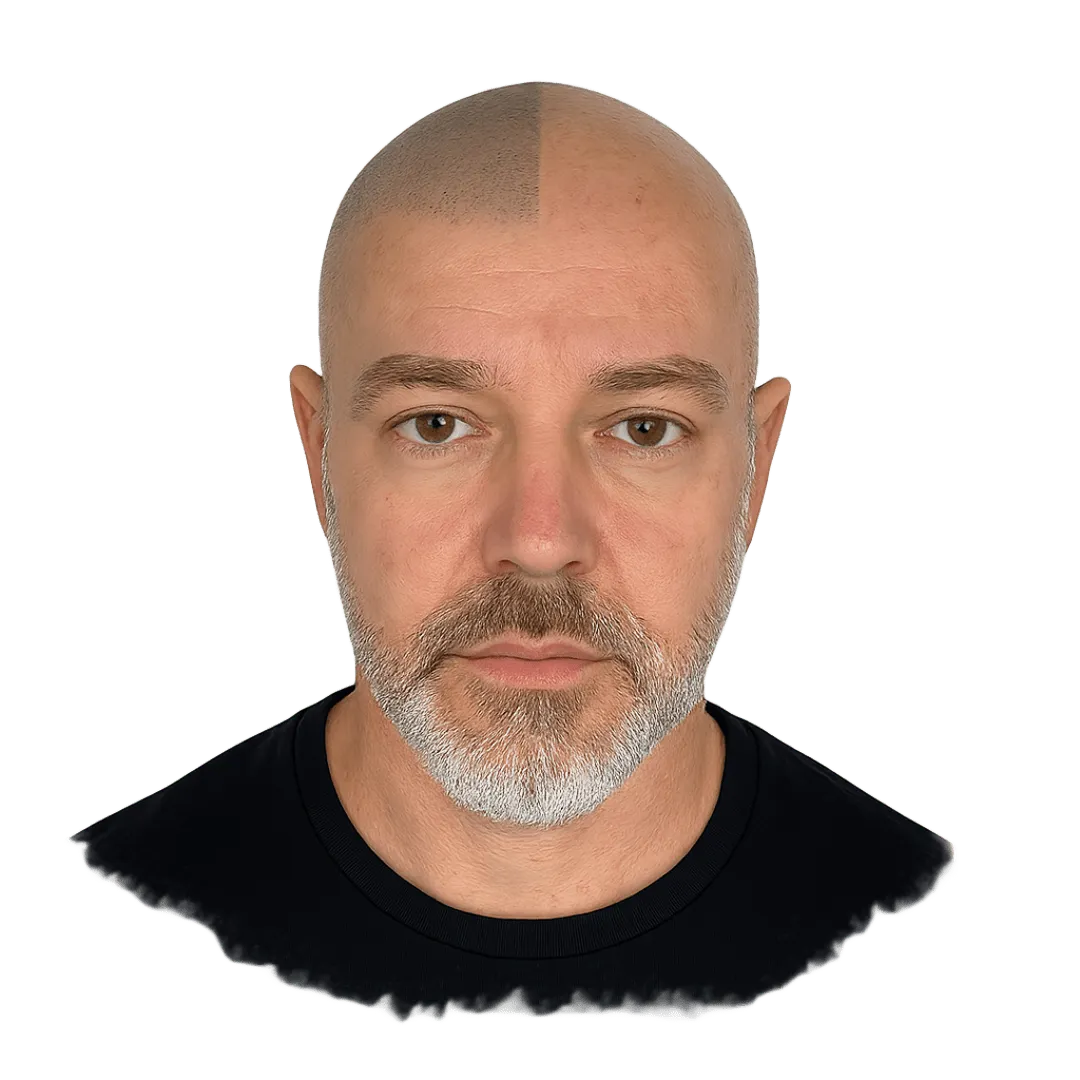 Micropigmentación capilar antes y después