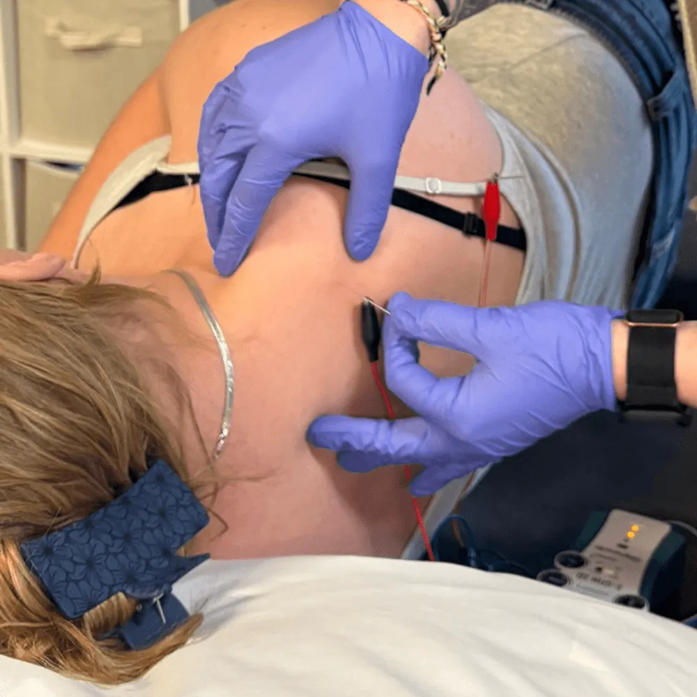 Dry needling services at Canyon Therapy in Cody WY