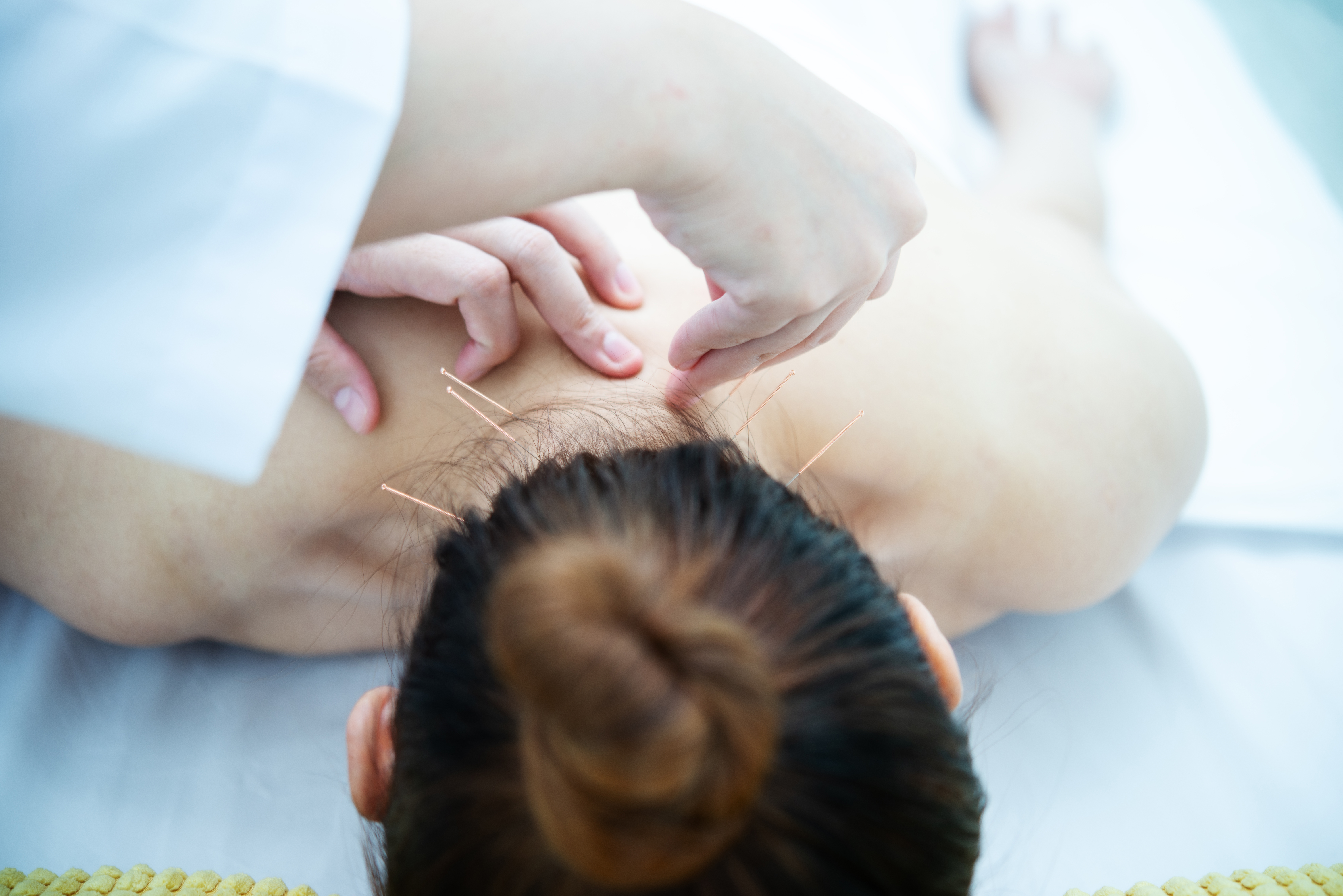 Acupuncture for Pain Relief and Recovery