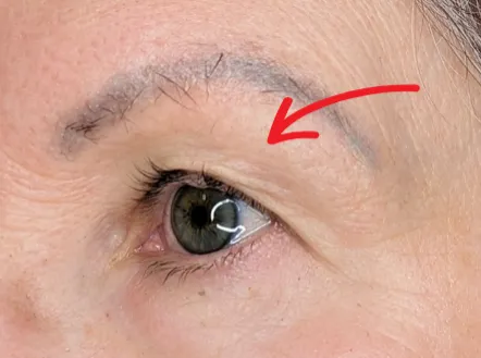 Schlupflider straffen ohne OP - geht das wirklich?