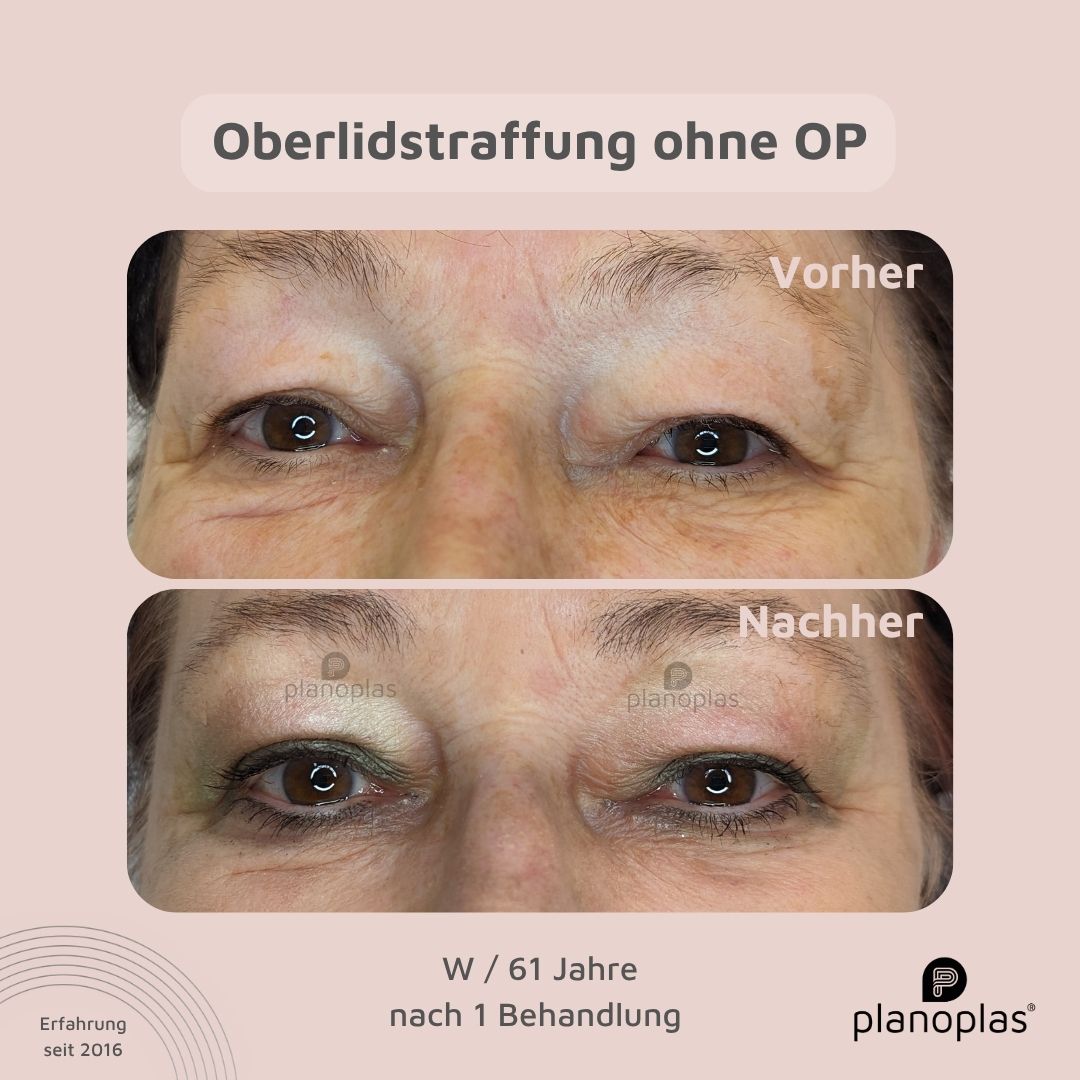 planoplas Plasma Pen Vorher Nachher Ergebnis einer Oberlidstraffung ohne OP frontal w61 geöffnete Augen