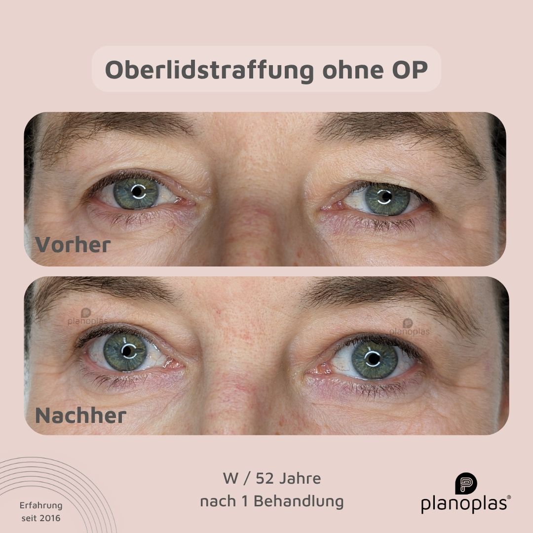 planoplas Plasma Pen Vorher Nachher Ergebnis einer Oberlidstraffung ohne OP frontal w52