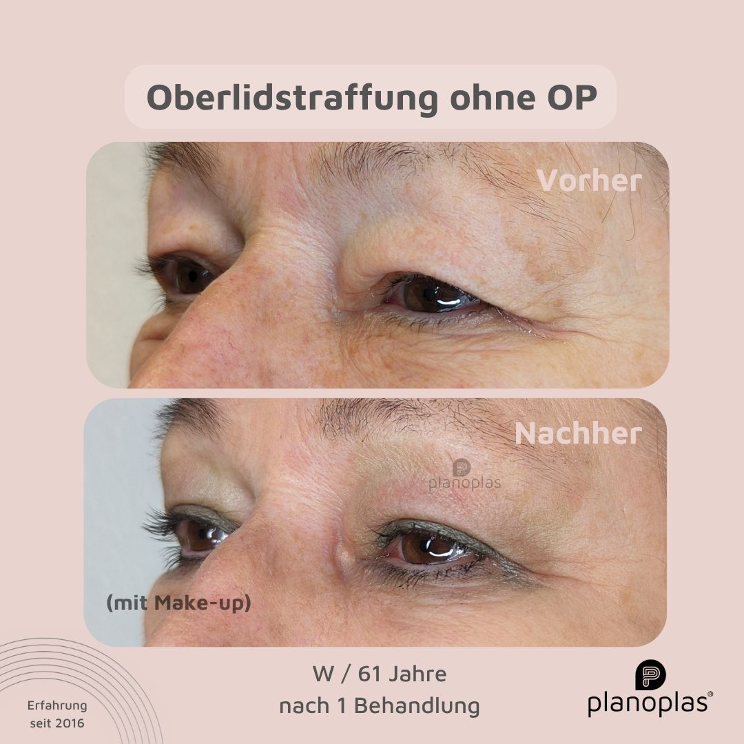 planoplas Plasma Pen Vorher Nachher Ergebnis einer Oberlidstraffung ohne OP w61 von links geöffnete Augen