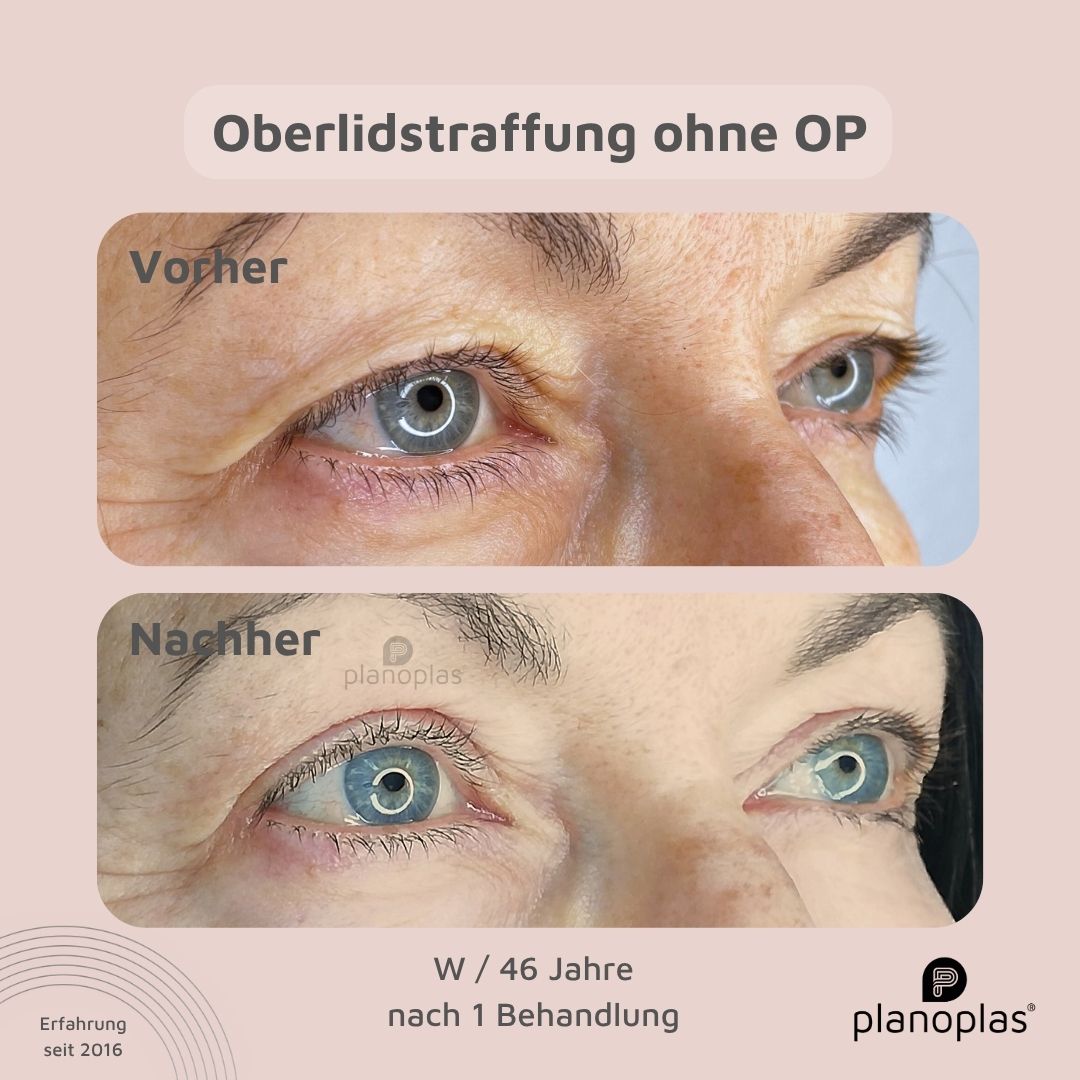 planoplas Plasma Pen Vorher Nachher Ergebnis einer Oberlidstraffung ohne OP w46 von rechts