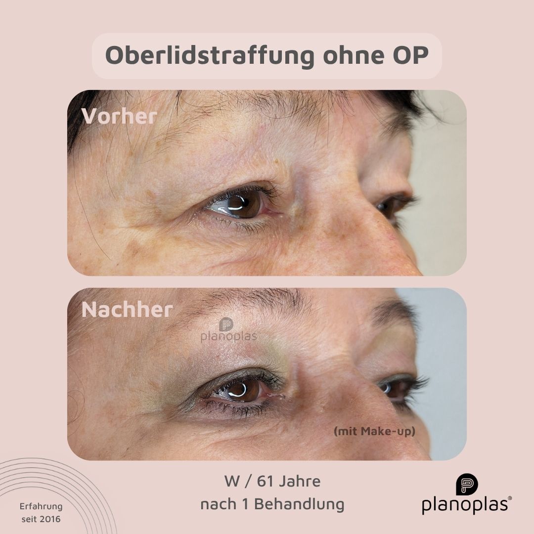 planoplas Plasma Pen Vorher Nachher Ergebnis einer Oberlidstraffung ohne OP w61von rechts