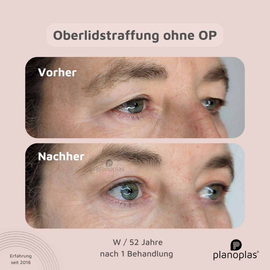 planoplas Plasma Pen Vorher Nachher Ergebnis einer Oberlidstraffung ohne OP w52 von rechts geöffnete Augen